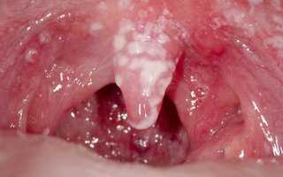 Кандидоз полости рта у детей и взрослых: фото, причины и лечение