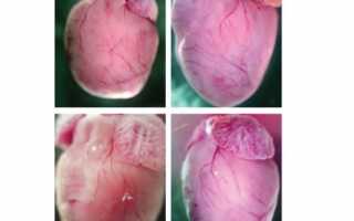 Что такое фиброз клапанного аппарата сердца