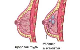 Почему появляются шарики в молочной железе у женщин