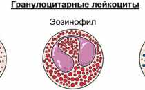 Незрелые клетки в анализе крови