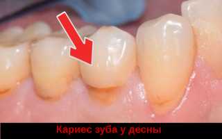Пришеечный кариес — почему портится зуб возле десны и как лечить