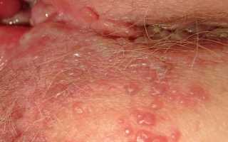 Как проявляется сифилис на половых губах