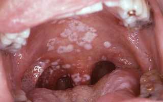 Хламидиоз горла