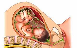 Лечение молочницы у беременных