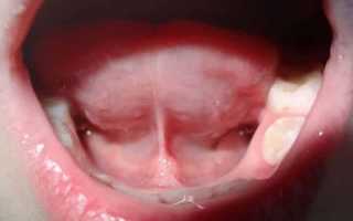 Почему опухло под языком — все возможные заболевания