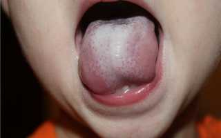 Что значит белый налет на языке у детей
