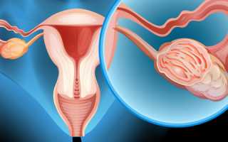 Рак яичников у женщин