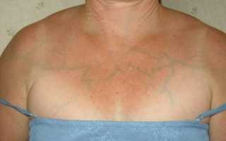 Почему на груди видны вены